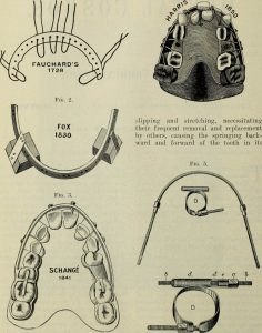 Apparecchi ortodontici inventati tra il 1728 e il 1850